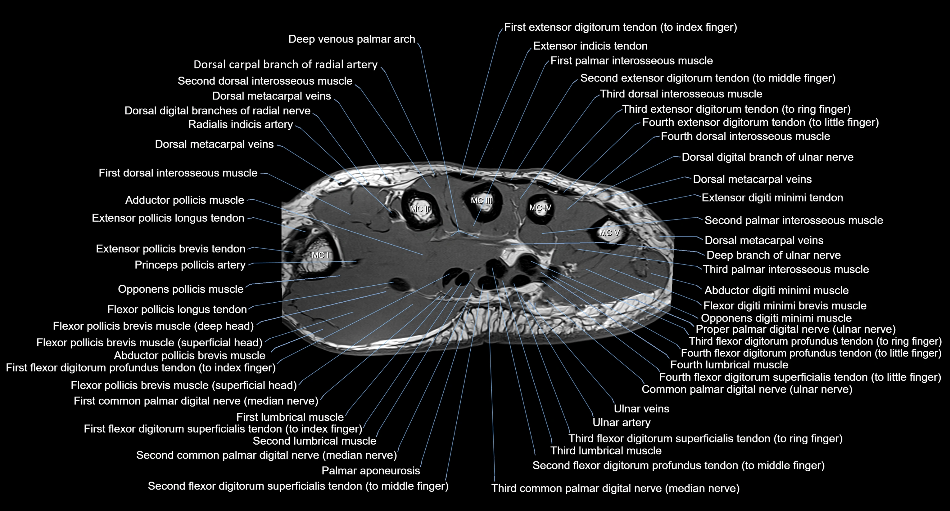 MRI wrist axial cross sectional anatomy 3T radiology  image-img-00001-00001.webp